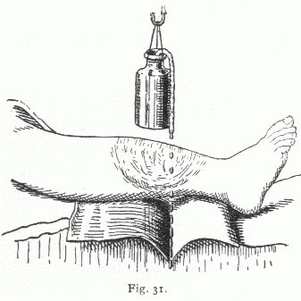 Lotion drips from a bottle through a flannel wick onto a wounded leg.